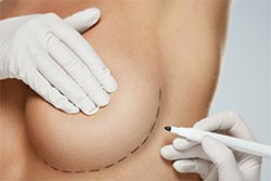 Before And After Images -  Breast Augmentation