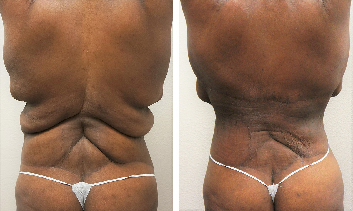 Lower Body Lift Surgery in Culver City, CA