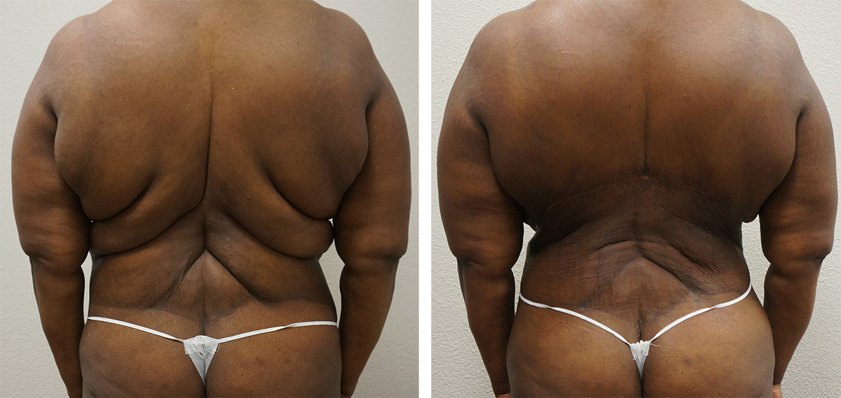 Circumferential Body Lift Case #64893 - The Plastic Surgery Group