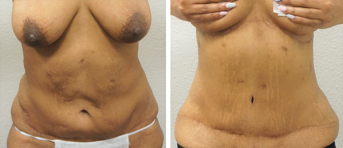 What Is an Inverted T Tummy Tuck?
