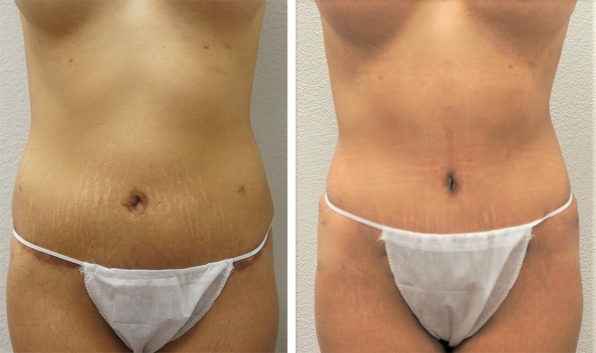 Would I benefit from a reverse tummy tuck and are there any non surgical  alternatives to this procedure? (photos)