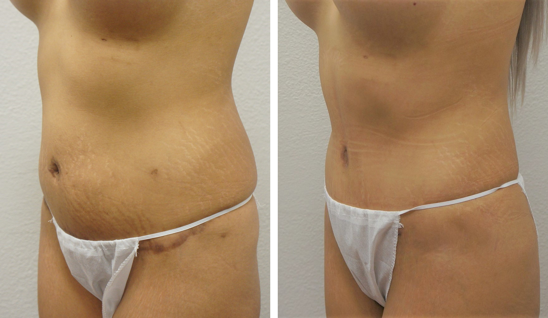 PDF] Extended reverse abdominoplasty