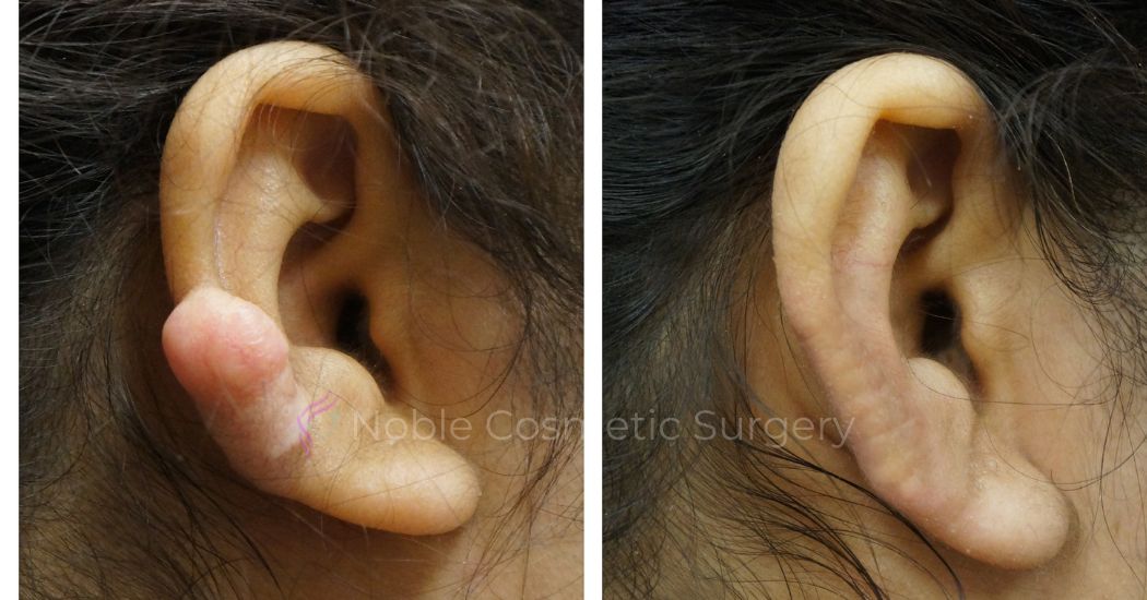 P1-00800E | Before and After Earlobe Repair