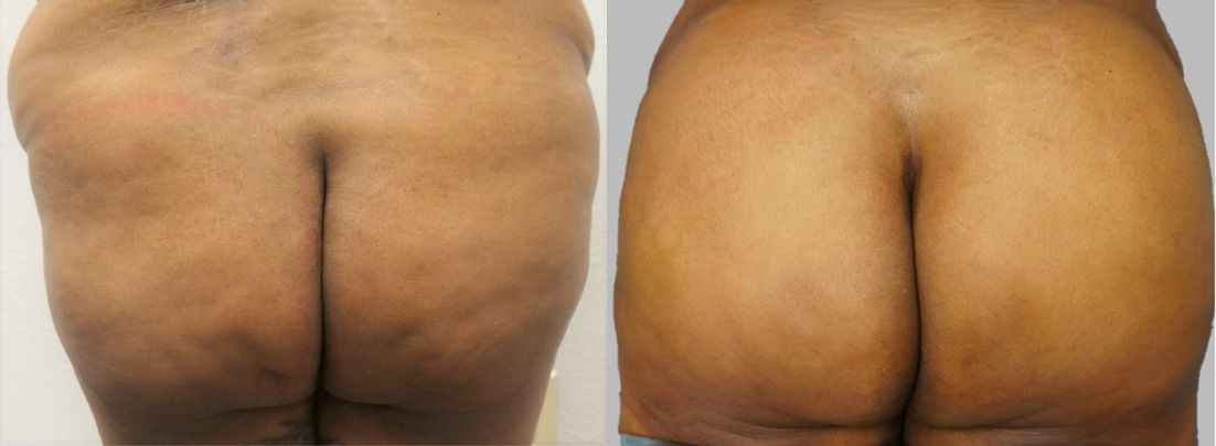 P1-00900 | Before and After Brazilian Butt Lift