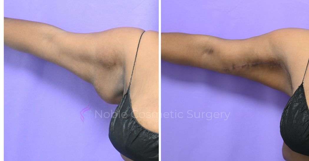 P1-13161 | Before and After Brachioplasty