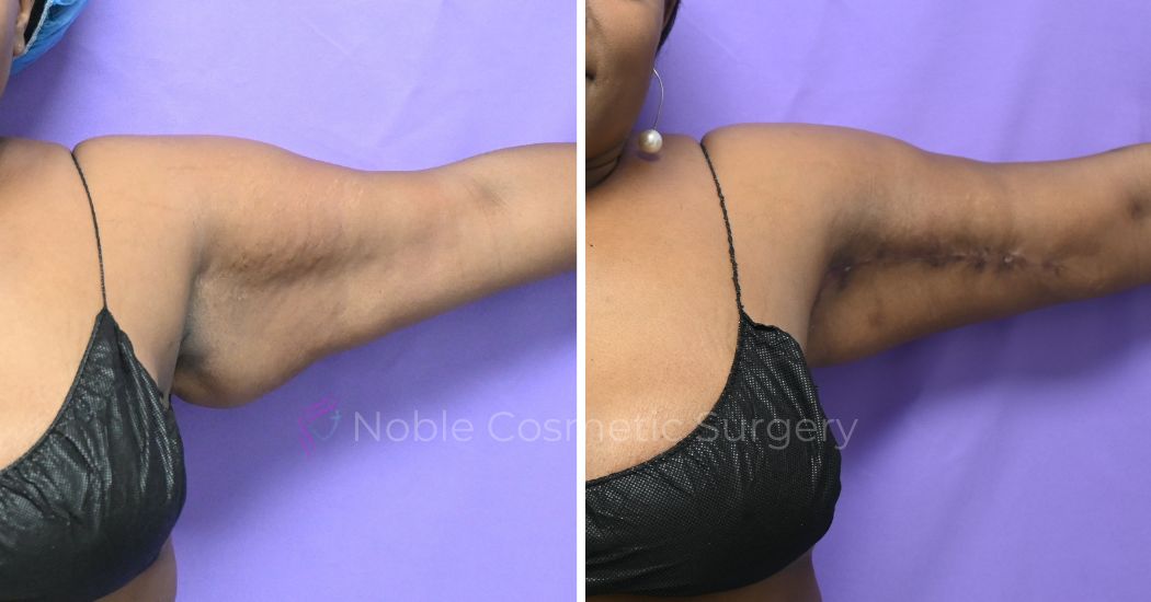 P1-13161 | Before and After Brachioplasty 2