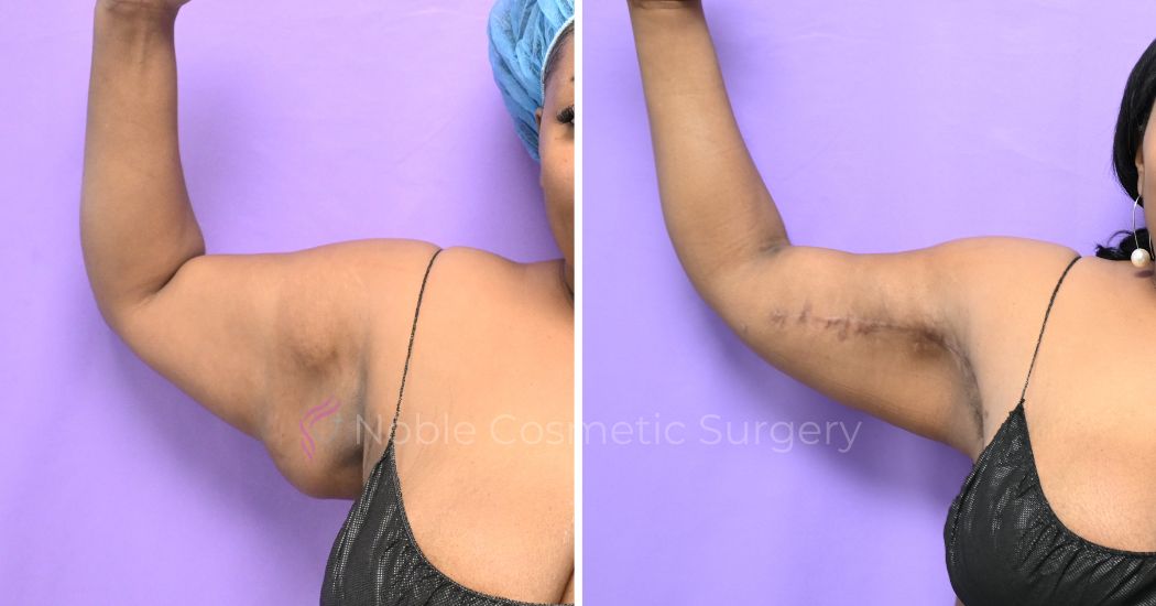 P1-13161 | Before and After Brachioplasty 3