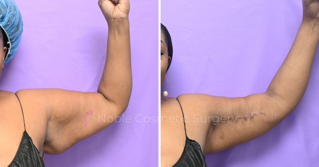 P1-13161 | Before and After Brachioplasty 4