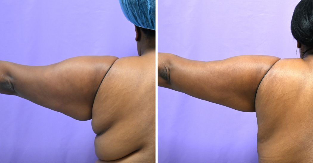 P1-13161 | Before and After Brachioplasty 5