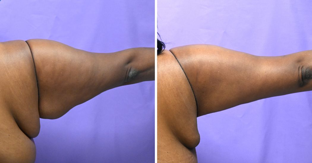 P1-13161 | Before and After Brachioplasty 6