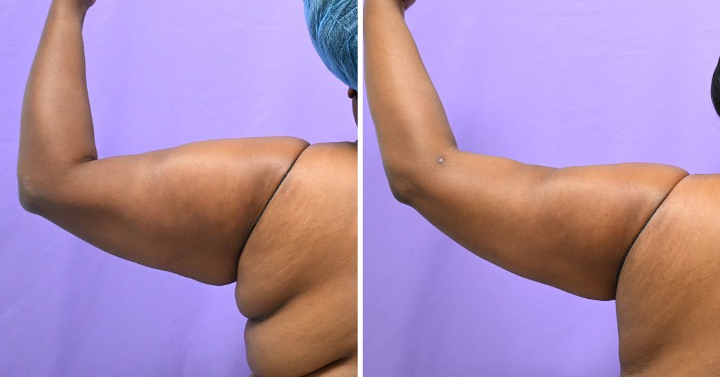 P1-13161 | Before and After Brachioplasty 7
