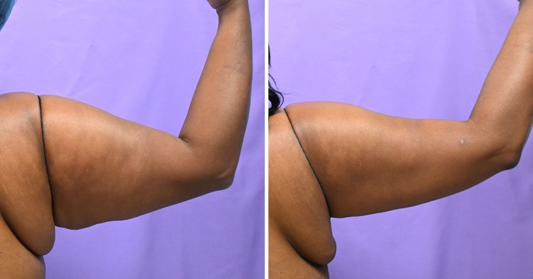 P1-13161 | Before and After Brachioplasty 8