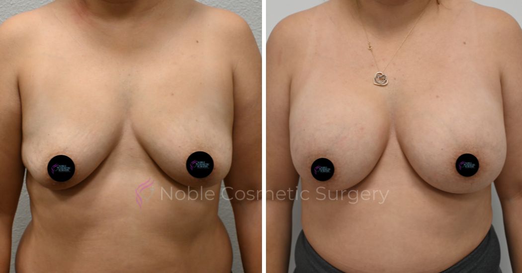 P1-15207 | Before and After Breast Augmentation