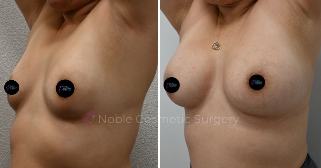 P1-15207 | Before and After Breast Augmentation 2