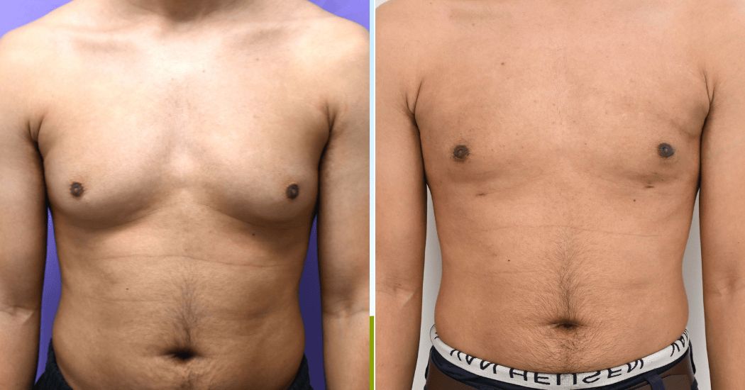 P1 Gynecomastia