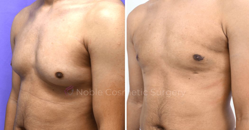 P1-19679 | Before and After Gynecomastia 3