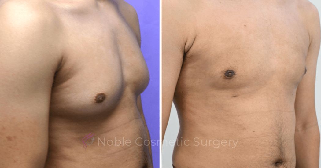 P1-19679 | Before and After Gynecomastia 2