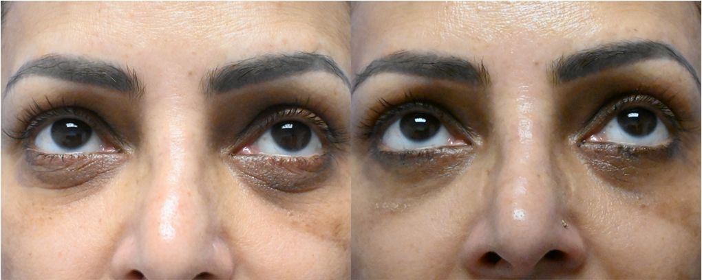 p1 Blepharoplasty