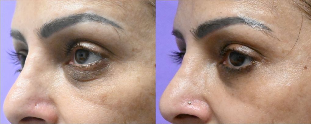 P1-19823 | Before and After Blepharoplasty 2