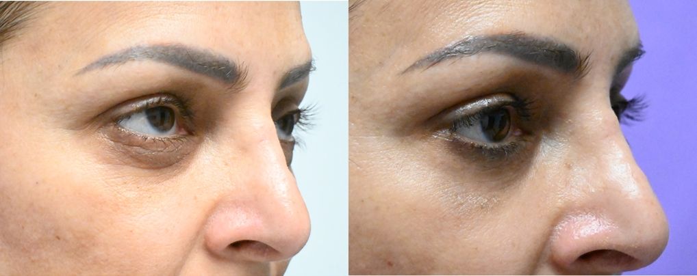 P1-19823 | Before and After Blepharoplasty 3