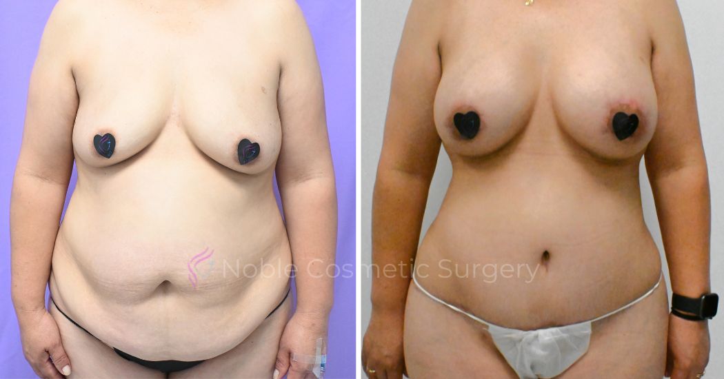 Mommy Makeover 2