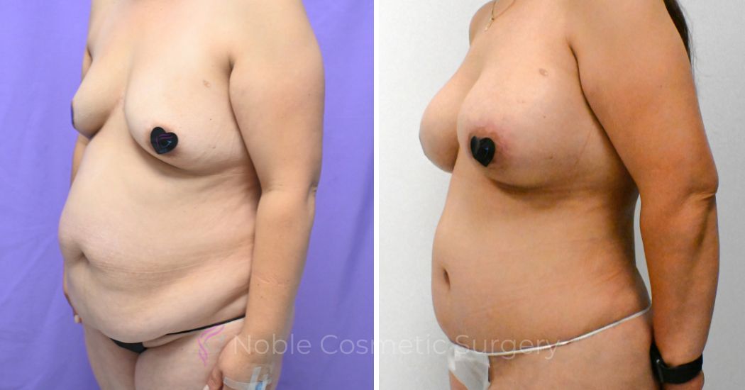 P1-MM19828 | Before and After Mommy Makeover 2