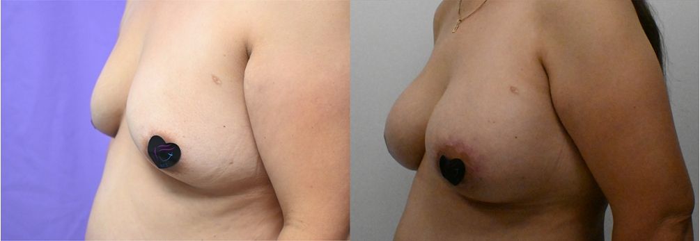 P1-19828 | Before and After Breast Augmentation with Lift 3