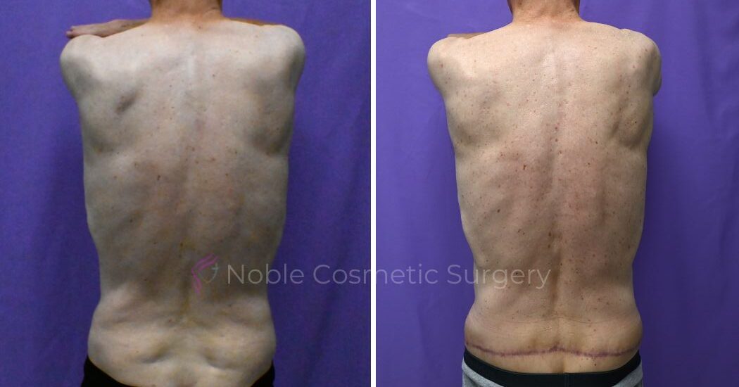 P1-20051 | Before and After Back Lift 2
