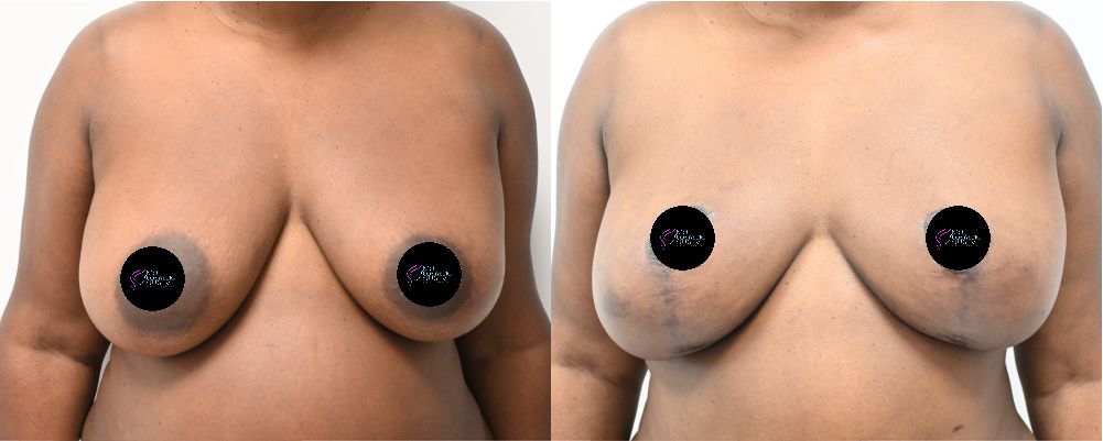 before and after breast reduction 1