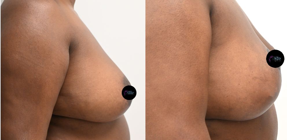 P1-3000 | Before and After Breast Reduction 2