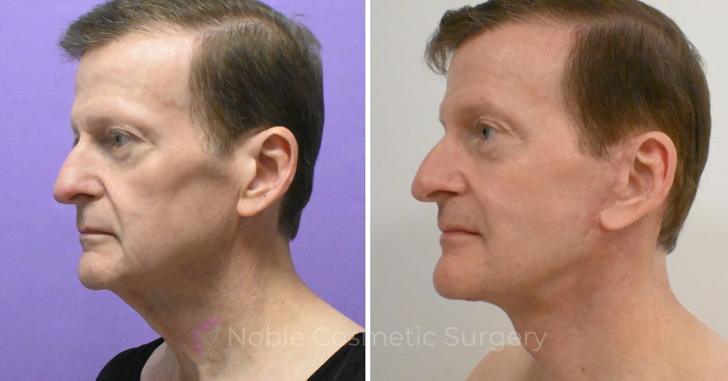 P1 Facelift and neck lift