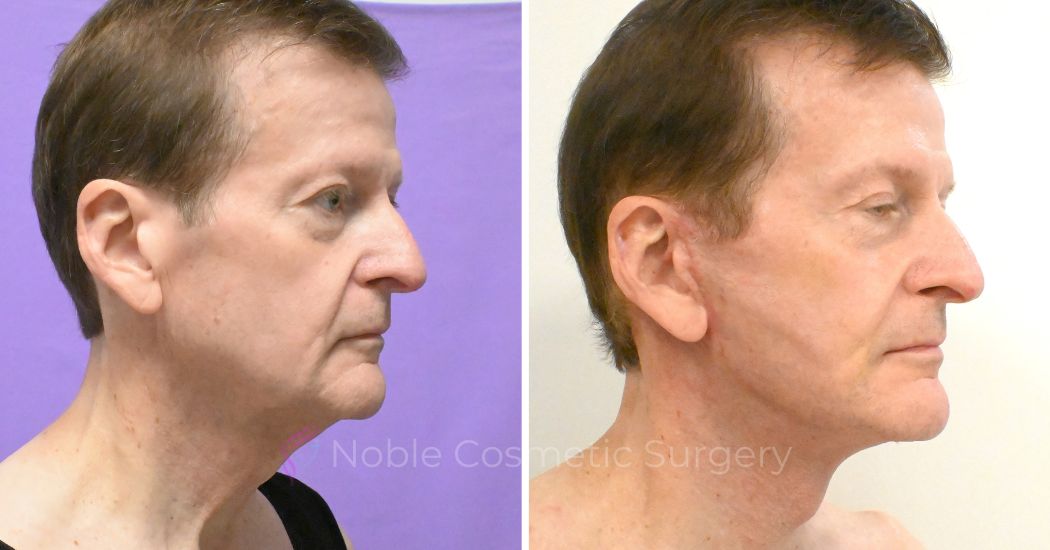 P1-F00800 | Before and After Facelift 3