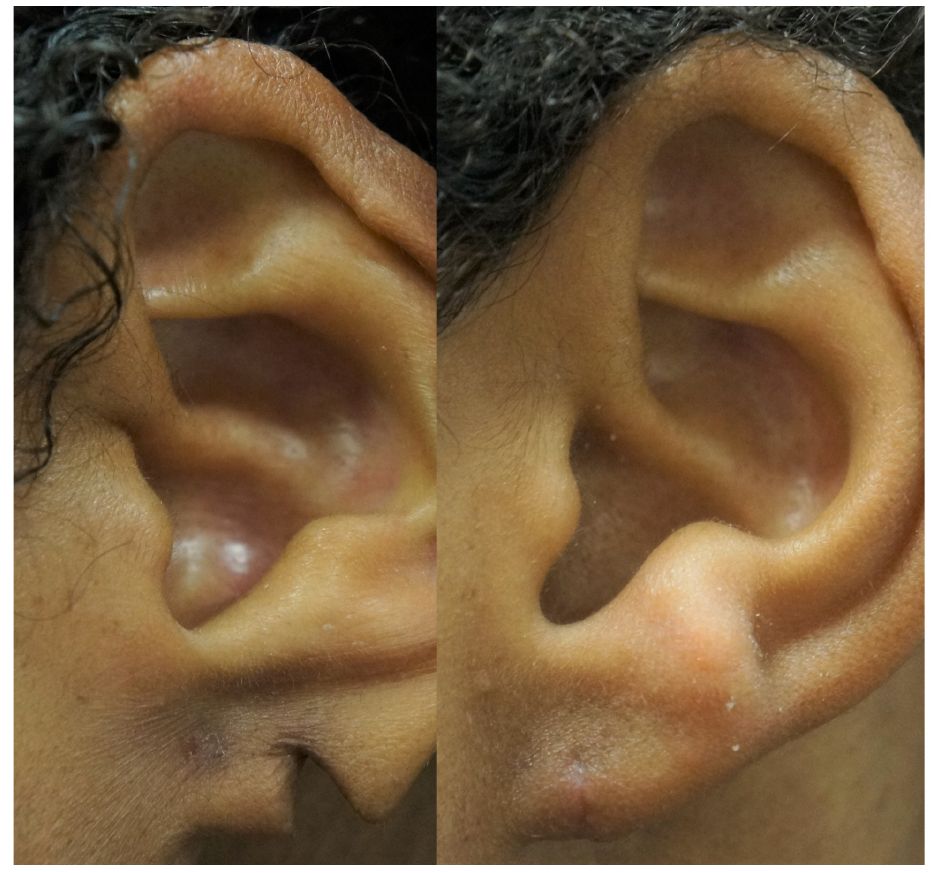 p2 earlobe repair