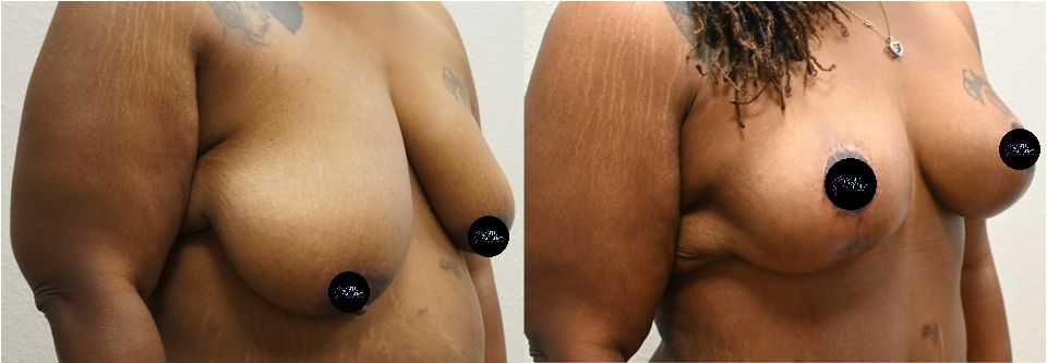 P2-00801 | Before and After Breast Reduction 2