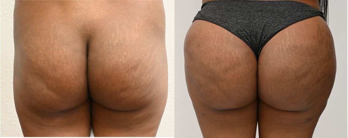 P2-00901-BBL | Before and After Brazilian Butt Lift