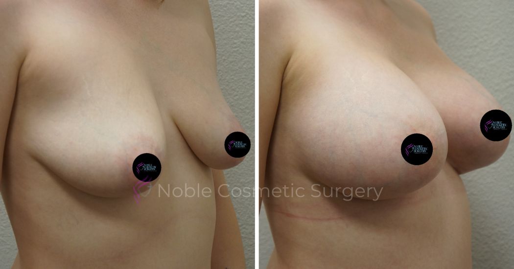 P2-17521 | Before and After Breast Augmentation 2