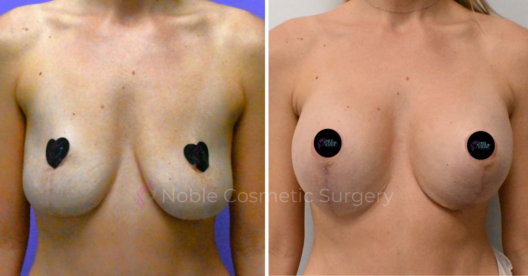 P2-19511 | Before and After Breast Augmentation with Lift