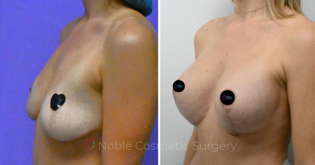 P2-19511 | Before and After Breast Augmentation with Lift 3