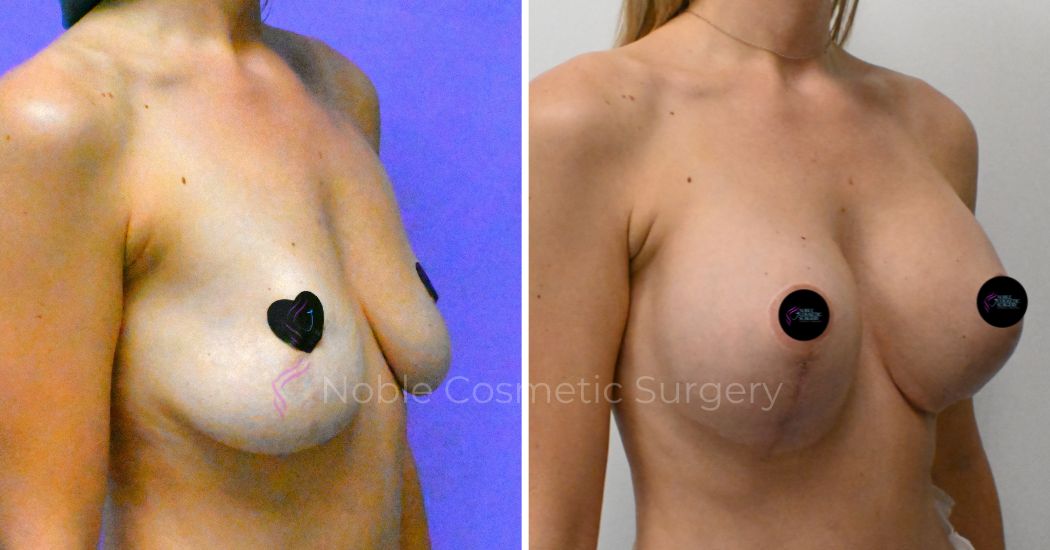 P2-19511 | Before and After Breast Augmentation with Lift 2