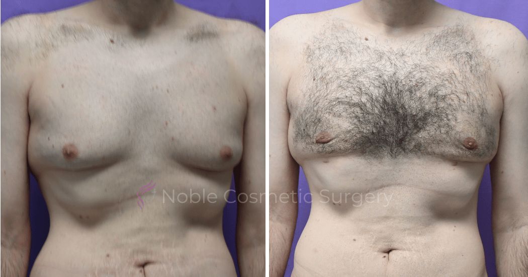 P3-19647 | Before and After Gynecomastia