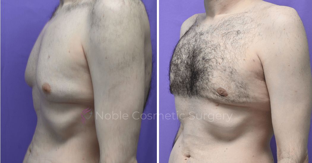 P3-19647 | Before and After Gynecomastia 2