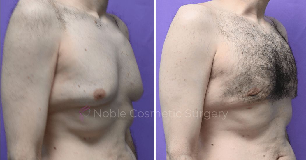 P3-19647 | Before and After Gynecomastia 3