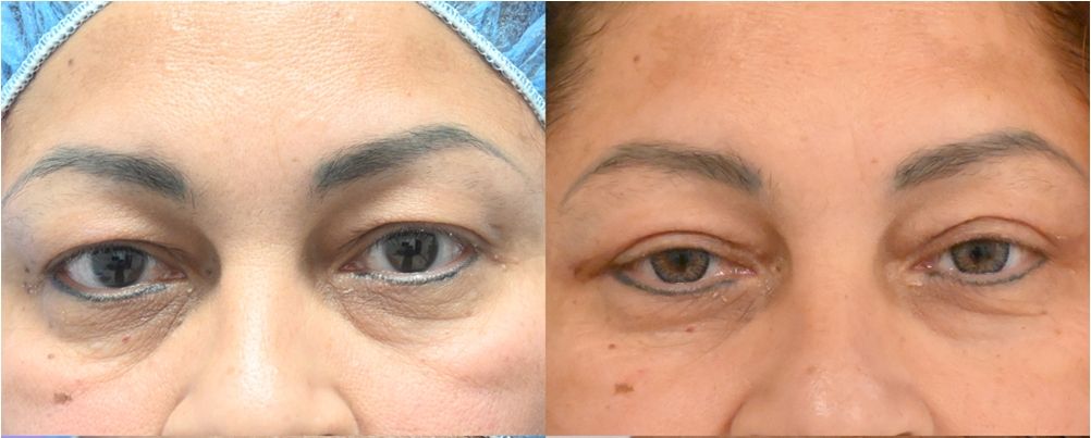 p2 Blepharoplasty