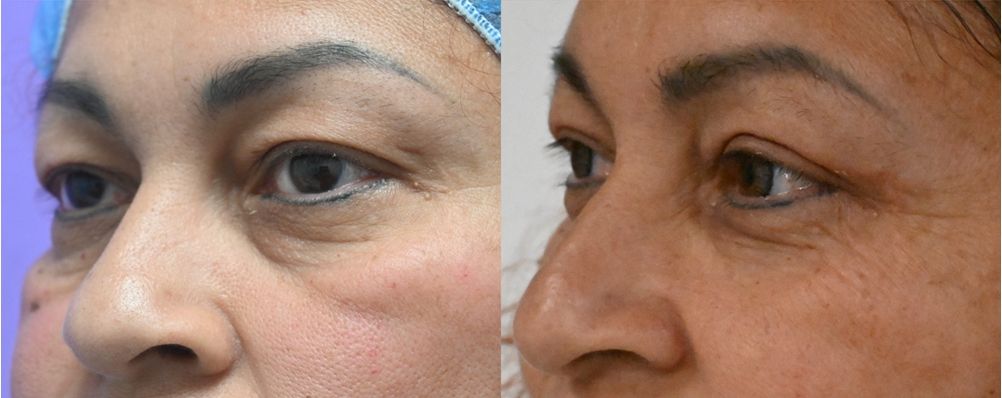 P2-19857 | Before and After Blepharoplasty 2