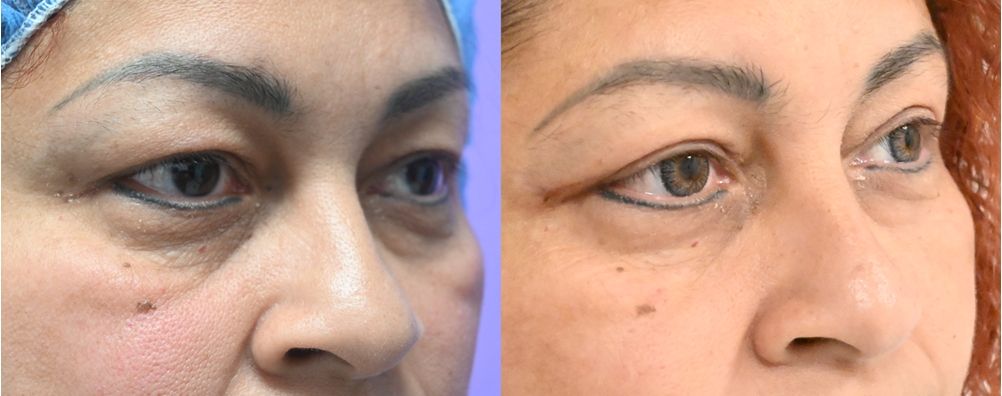 P2-19857 | Before and After Blepharoplasty 3