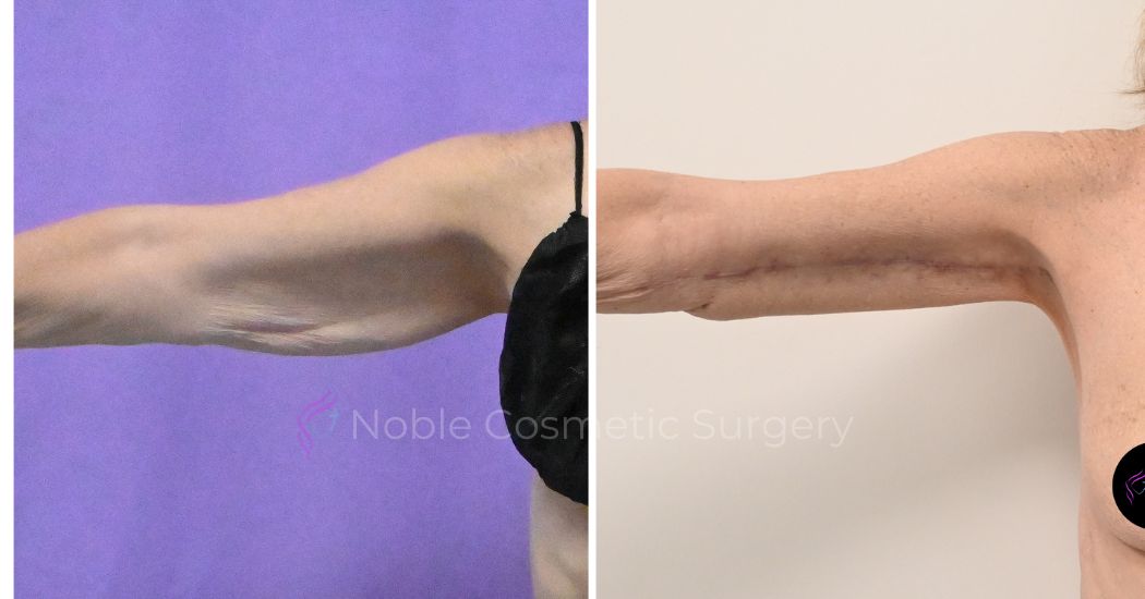 P2-20003 | Before and After Brachioplasty