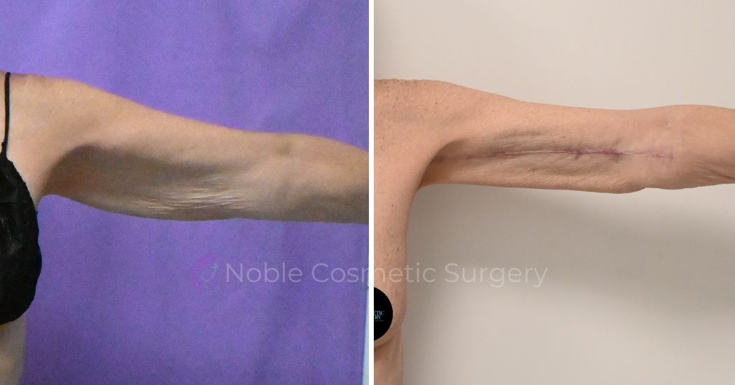 P2-20003 | Before and After Brachioplasty 2