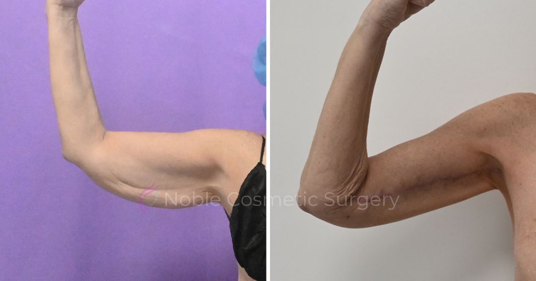 P2-20003 | Before and After Brachioplasty 3