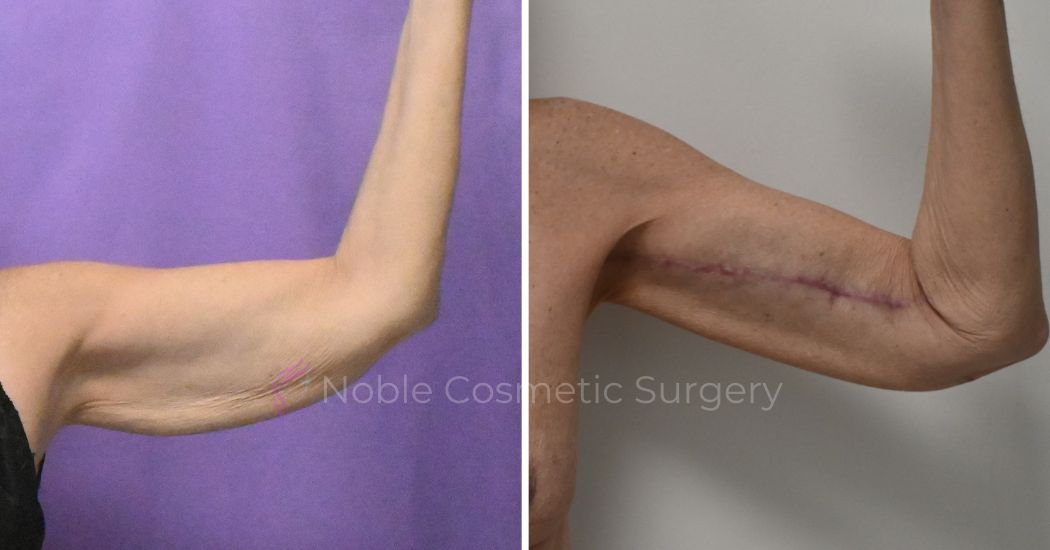P2-20003 | Before and After Brachioplasty 4