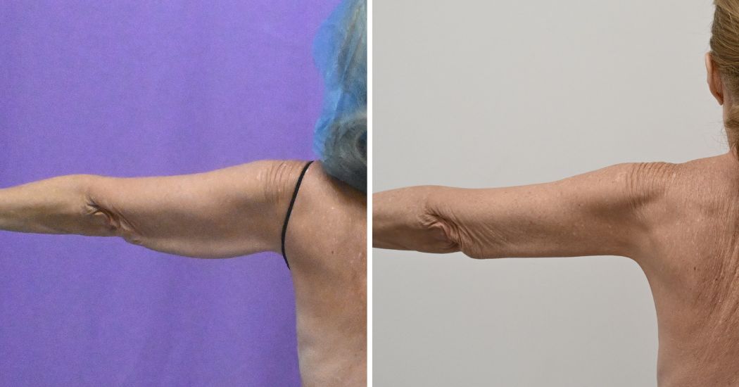 P2-20003 | Before and After Brachioplasty 5